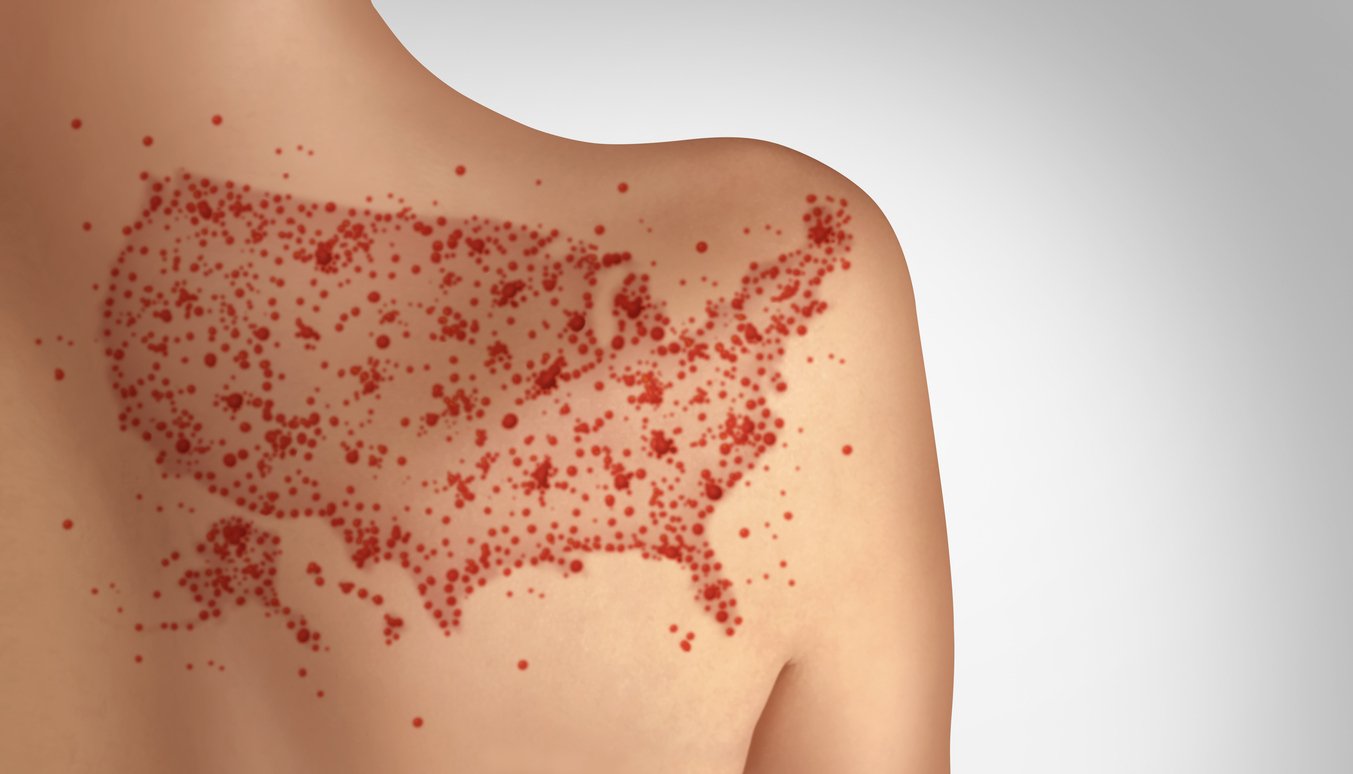 Texas reports lowest increase in measles cases since February outbreak